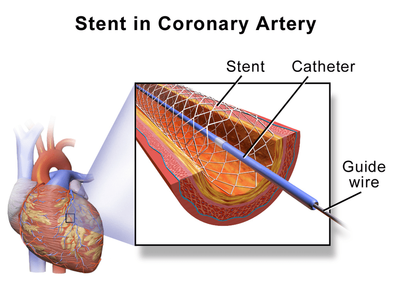 3D rendering of a heart stent