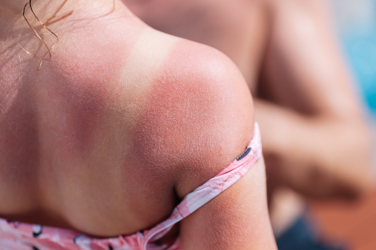 Tips for Soothing a Sunburn