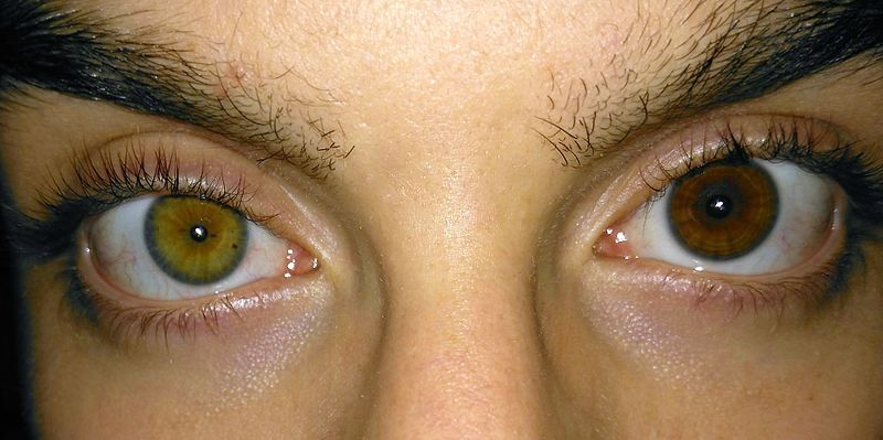 A pair of eyes with heterochromia