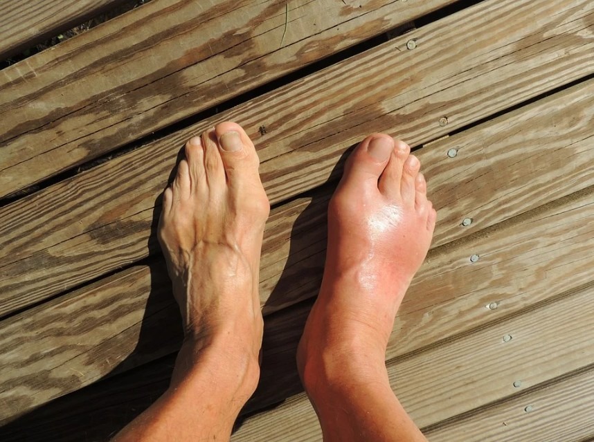 The Most Common Mistakes People With Gout Make