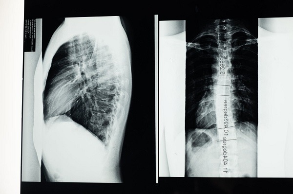 an x-ray picture of side of chest and skeletal bone