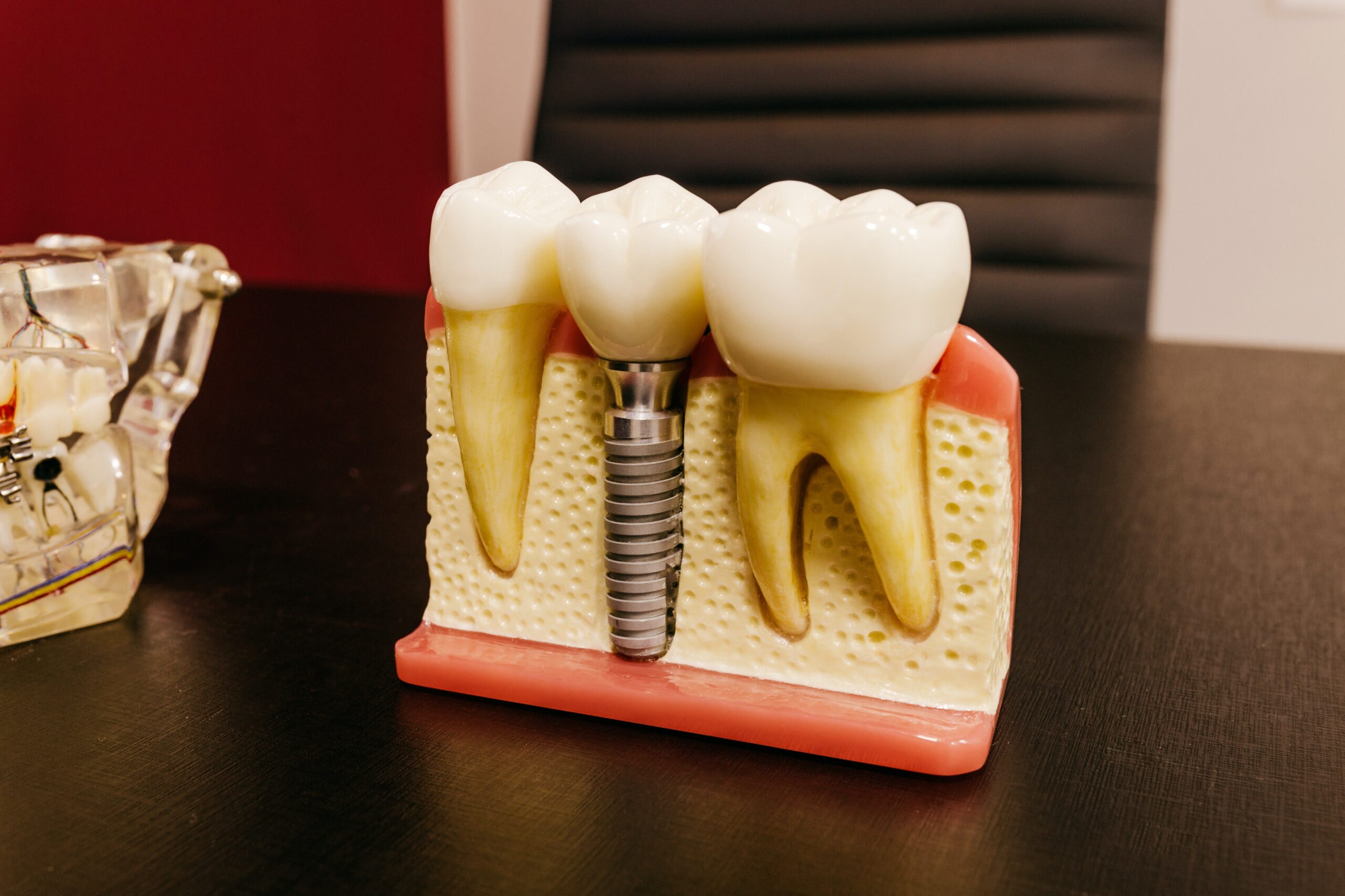 7 Reasons Why People Opt To Have Teeth Implants