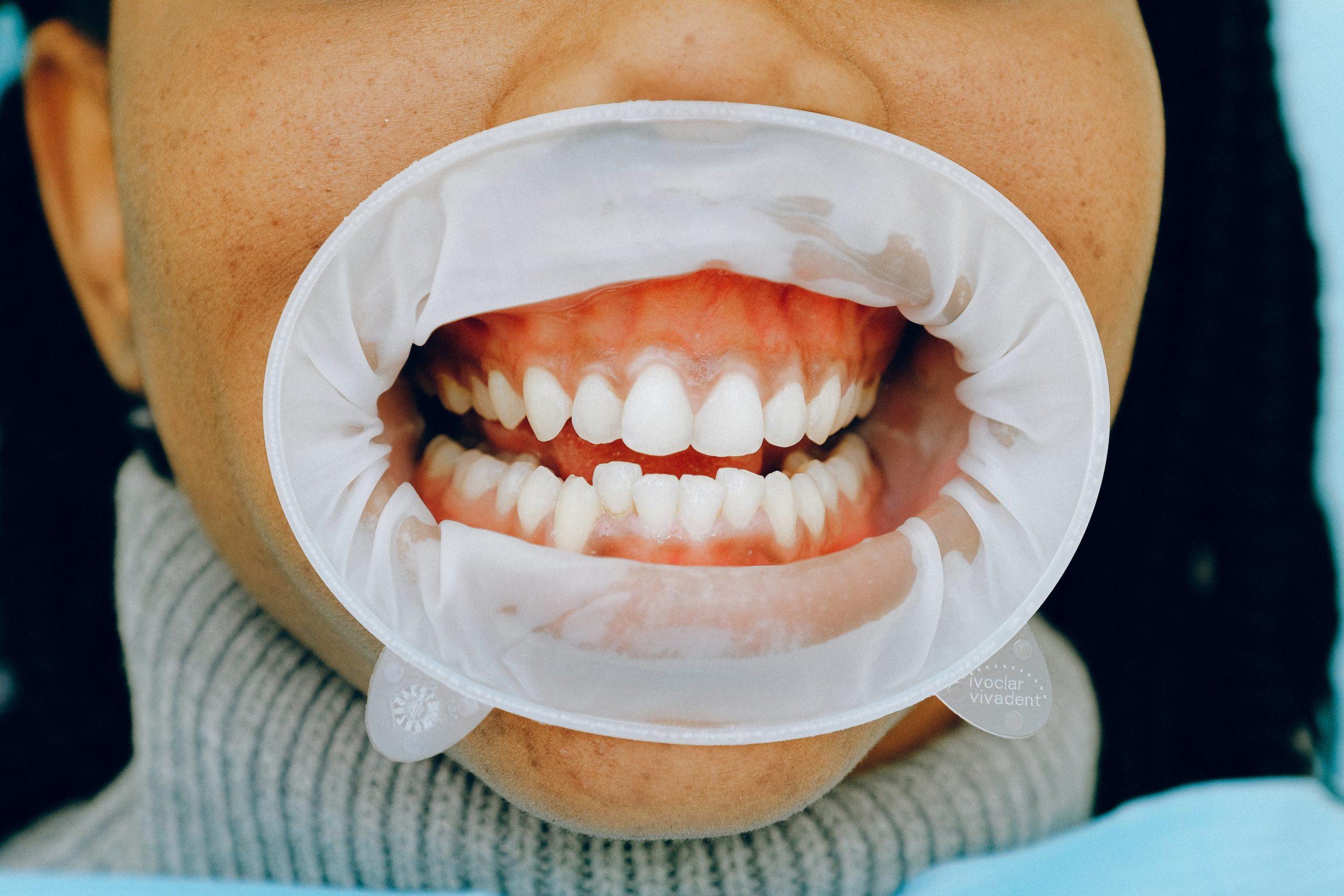 How to Prevent Gum Disease