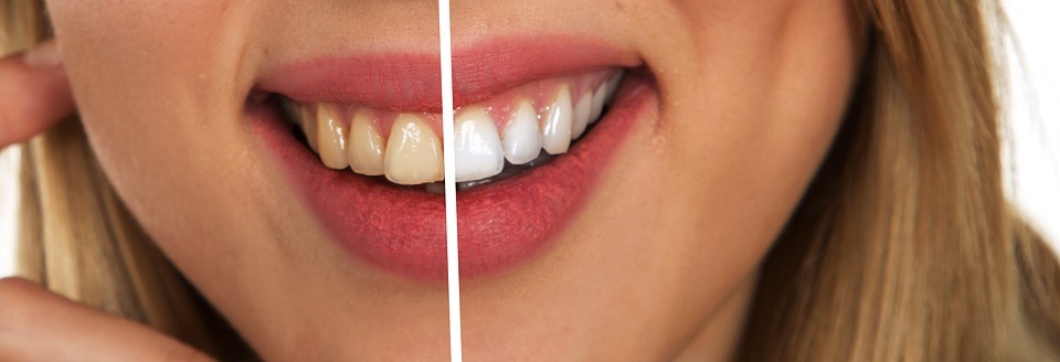 Everything You Need To Know About Teeth Whitening