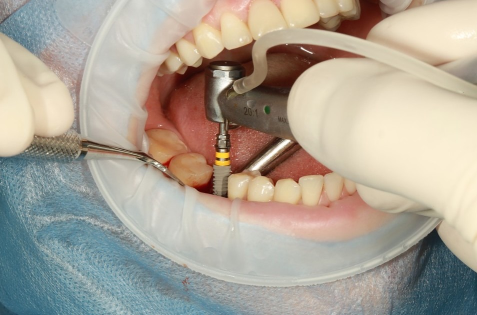 What are the major benefits of getting dental implants?