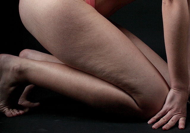 cellulite on a thigh