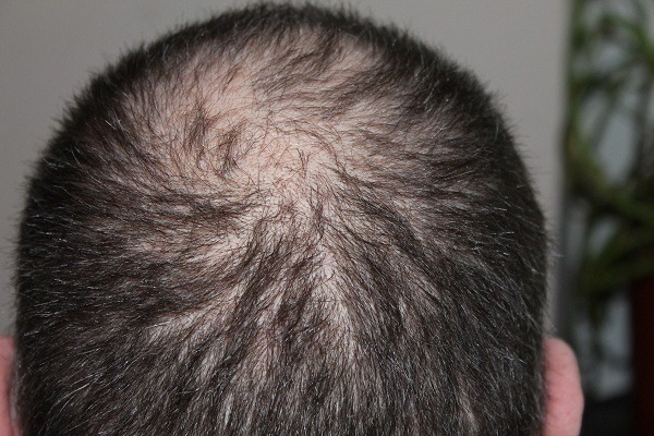 Living Well What are The Common Causes of Hair Loss