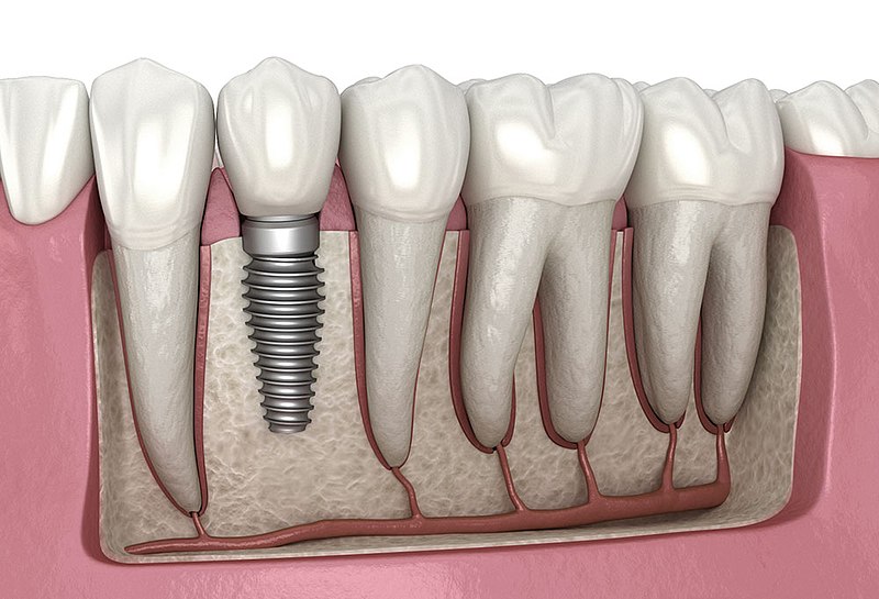 Signs you need dental implants