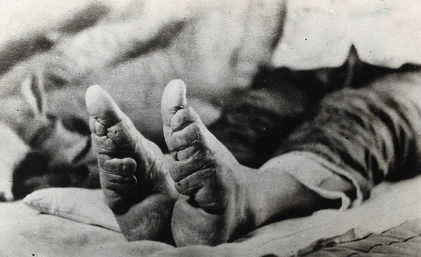 Feet_of_a_Chinese_woman,_showing_the_effect_of_foot-binding