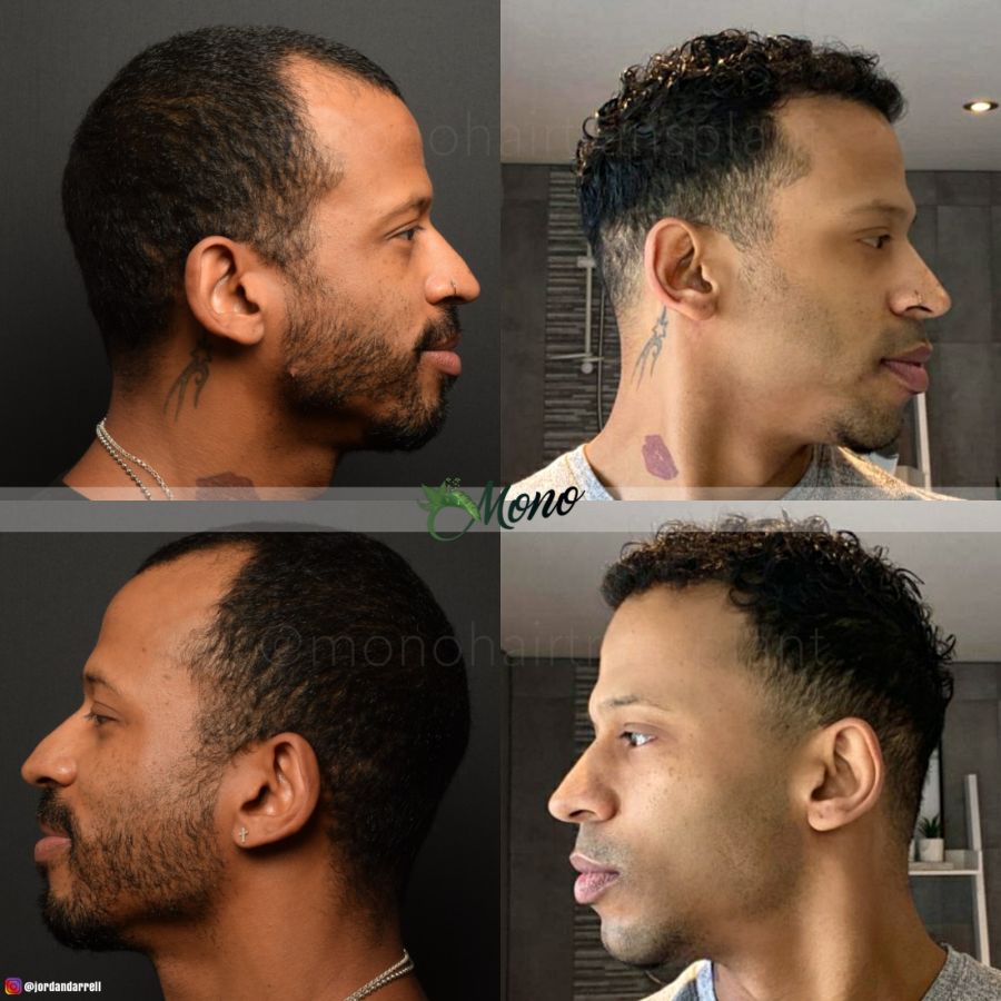 Trend for Male: Hair Transplant Turkey Prices