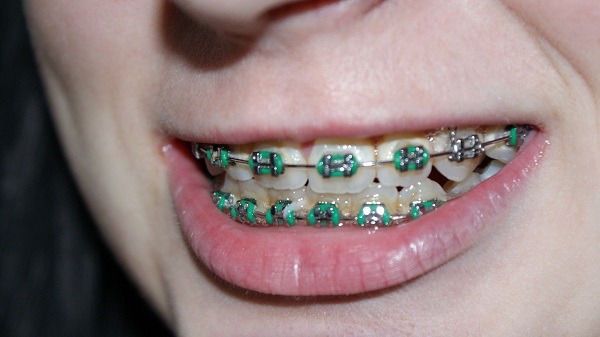 5 Important Things To Keep In Mind When Considering Braces