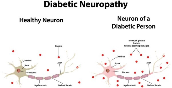 Can diabetic nerve damage be reversed