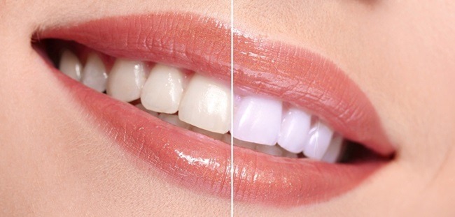 What Are The Advantages of Teeth Whitening
