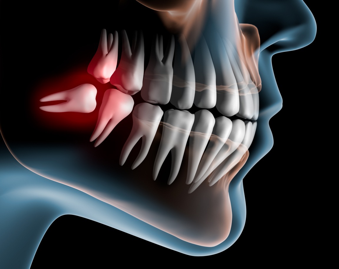 Lying Wisdom Tooth in the Lower Jaw - 3D Rendering