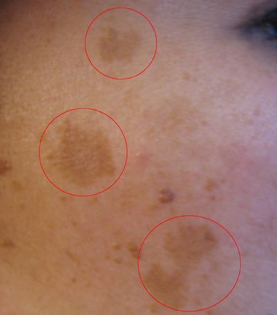 What is Melasma and How can we Treat it