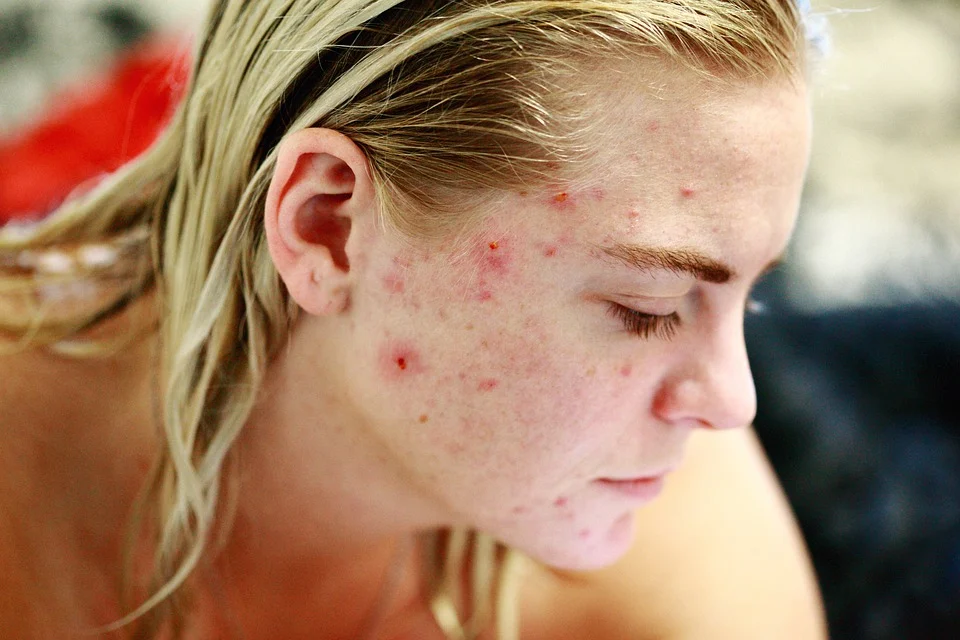 Love the Skin Your In This Is How to Treat Hormonal Acne