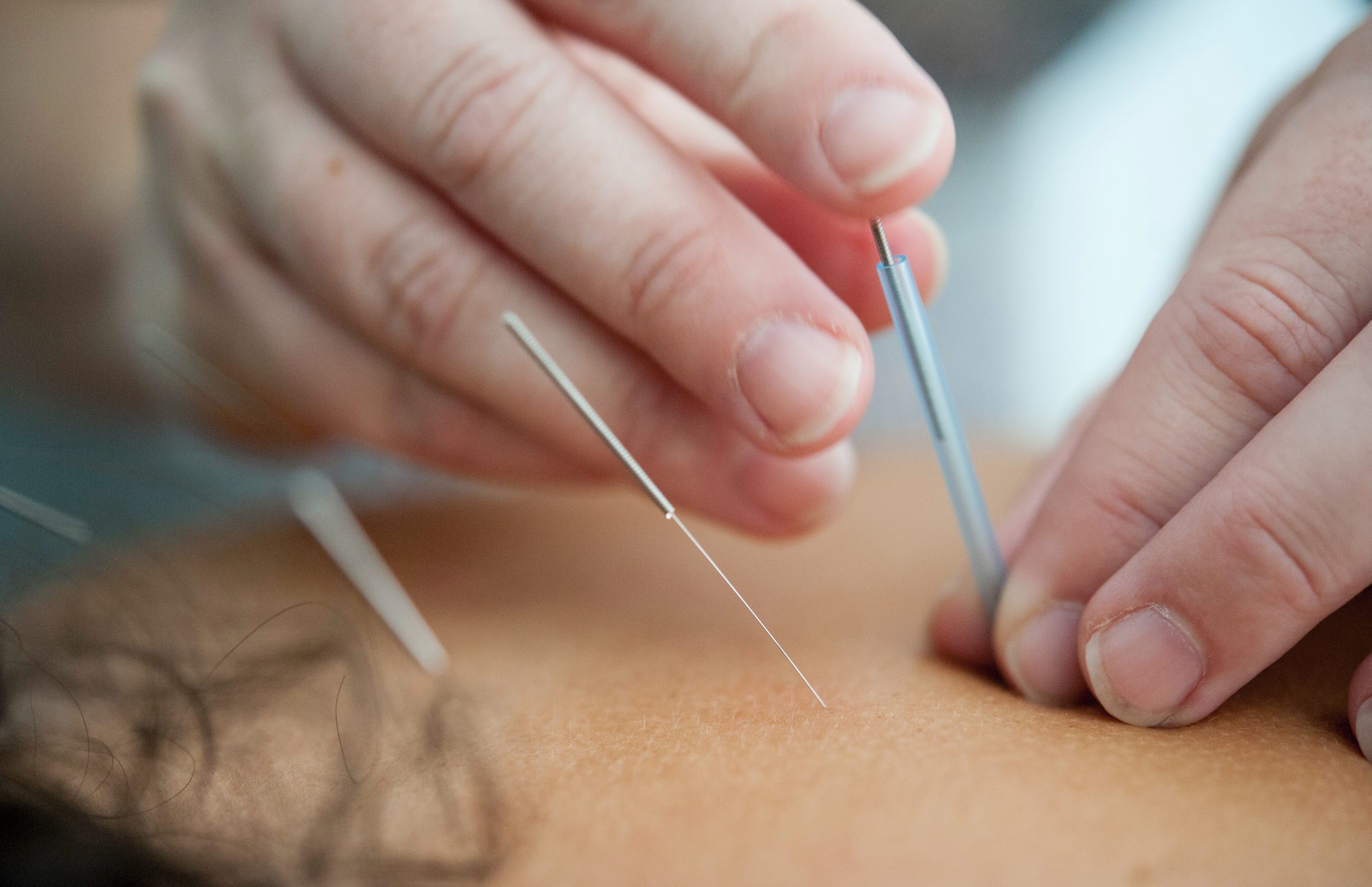 Acupuncture ancient healing