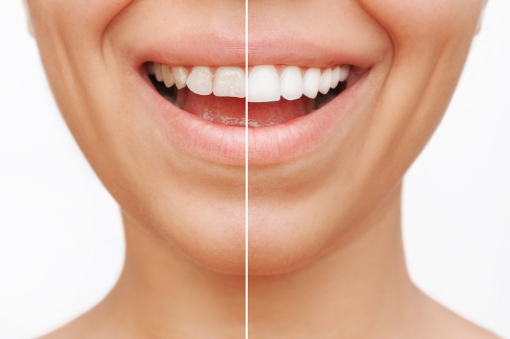 5 Tips for Straightening Your Teeth in 2023