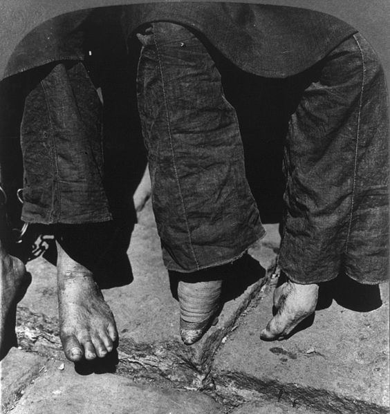 A comparison between a woman with un-bound feet (left) and a woman with bound feet in 1902