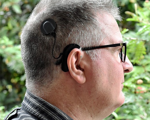 Cochlear implant user