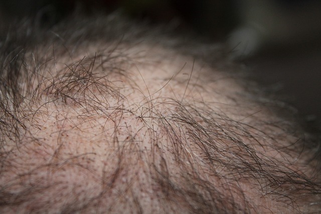 5 Benefits of Plasma Therapy for Hair Loss