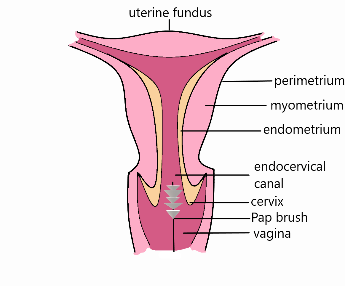 Uterine Fibroid Embolization Procedure