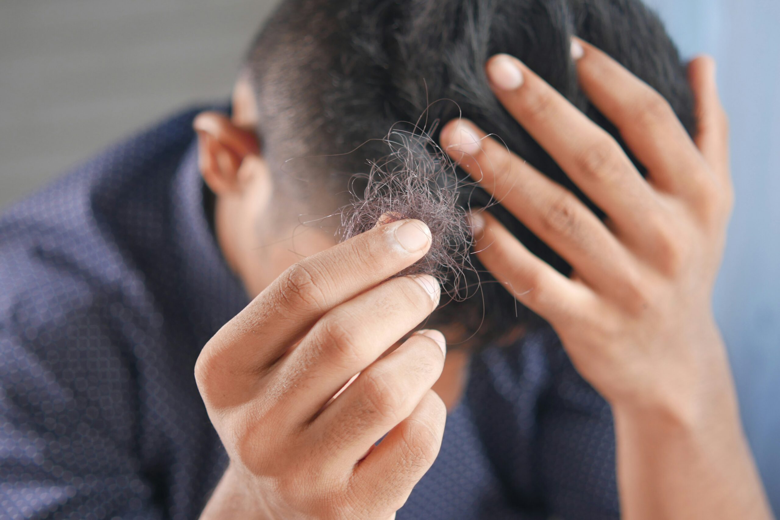 5 Ways You Might Be Making Your Hair Loss Worse